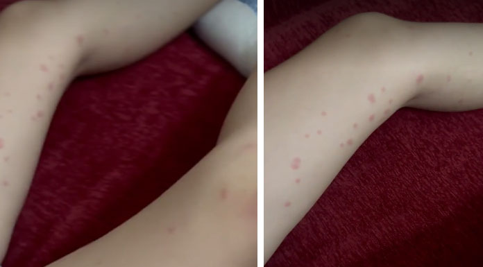 Limasol sahillerinde kum piresi alarmı